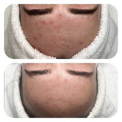 Before and after chemical peel