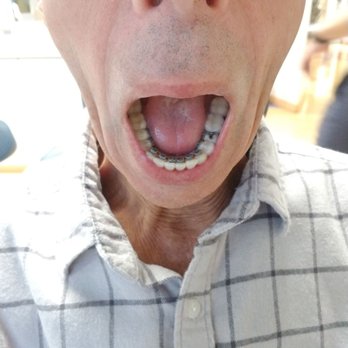MacGinnis Orthodontics - My teeth were straight after only 8 weeks - Orthodontists Near Me - Fullerton, California