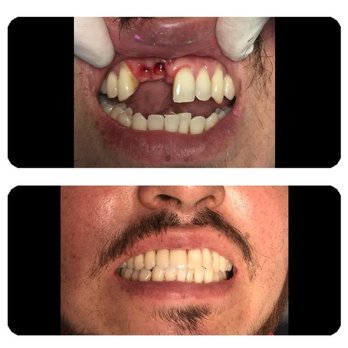Guillermo J Rubiano, DDS - Teeth knocked out. Replaced with implants and crowns. - General Dentistry Near Me - San Pedro, California