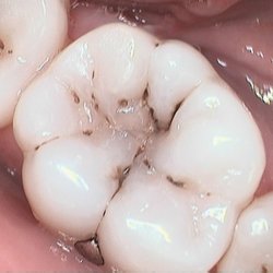 Magnolia Dental - Photo of a tooth with standard dental decay we often diagnose.