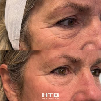 Holden Timeless Beauty- Fallbrook - CO2 Laser - Medical Spas Near Me - Fallbrook, California