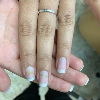 Robertson Nail - Green Nail Syndrome infection. - Nail Salons Near Me - Beverly Hills, California Robertson Nail - Green Nail Syndrome infection. - Nail Salons Near Me - Beverly Hills, California