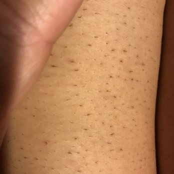 SUGARED + BRONZED - Color depositing in hair follicles on thigh - Tanning Near Me - Hermosa Beach, California SUGARED + BRONZED - Color depositing in hair follicles on thigh - Tanning Near Me - Hermosa Beach, California