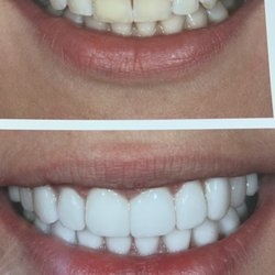 Randy L Furshman, DDS - Porcelain ultra-thin no-prep veneers