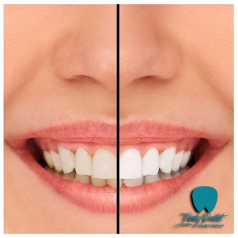 Charles Calhoun - Before and after for teeth whitening - General Dentistry Near Me - Tulsa, Oklahoma