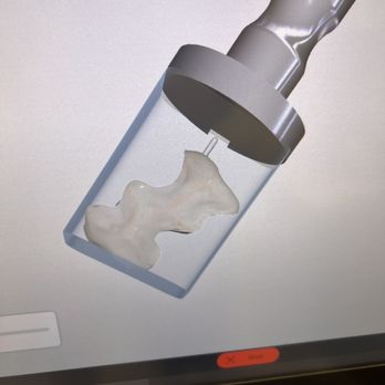 Applegate Dentistry & MedSpa - Digital scan of my tooth that creates a 3D model of the partial crown that needs to created - General Dentistry Near Me - Covington, Kentucky