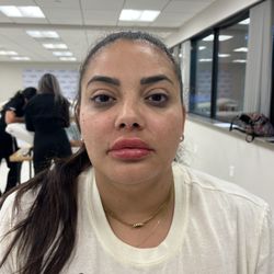 Intentional Wellness Medspa - After lipflip filer