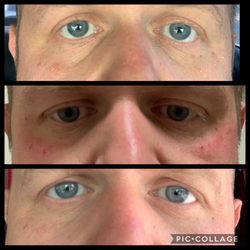 Premier Spa & Laser Center - Before after and healed.