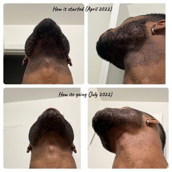 Peach Fuzz - Laser Hair Removal Near Me - Valley Stream, New York