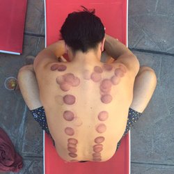 Kristie Shapiro, OMD - Cupping results- It was painless and everyone thought I was a pro swimmer or that I just got into a fight with an octopus.