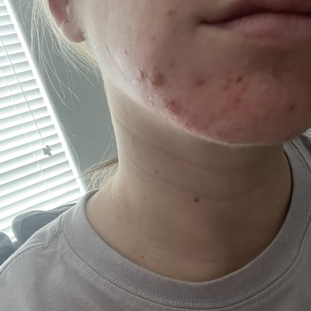 hard to capture but you can see the dry patches around my break out. This is a day after the hydro facial.