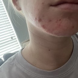 hard to capture but you can see the dry patches around my break out. This is a day after the hydro facial. hard to capture but you can see the dry patches around my break out. This is a day after the hydro facial.