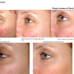 Queens Laser and Electrolysis Hair Removal - Laser Genesis Skin Rejuvinating, before and after