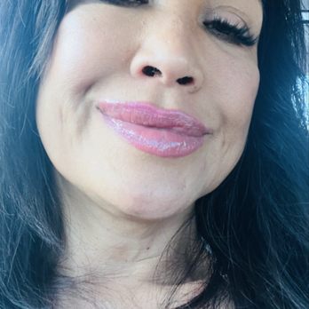 Revive Beauty Aesthetics - After Restylane eye light for sunken eyes and Restylane L for cheeks . - Skin Care Near Me - Rosemead, California