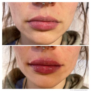 Laser Bar Medspa - Lip filler - Medical Spas Near Me - Dallas, Texas Laser Bar Medspa - Lip filler - Medical Spas Near Me - Dallas, Texas