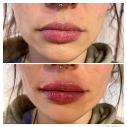 Laser Bar Medspa - Lip filler