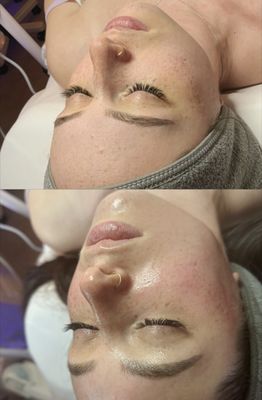 Custom Facial - Want to see immediate results that will give you that infamous glow? A Custom Facial is the perfect treatment for you. Receive a tailored treatment for your skin’s specific needs that will leave you feeling refreshed, plumped and glowing. Receive 15% off as a new client and get a free consultation today! Custom Facial - Want to see immediate results that will give you that infamous glow? A Custom Facial is the perfect treatment for you. Receive a tailored treatment for your skin’s specific needs that will leave you feeling refreshed, plumped and glowing. Receive 15% off as a new client and get a free consultation today!