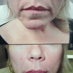 Bella Aesthetics - Juvederm before and after done by Rhonda Musolino