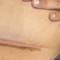 Baby Bump Studios - Tech cut me above my c-section scar
