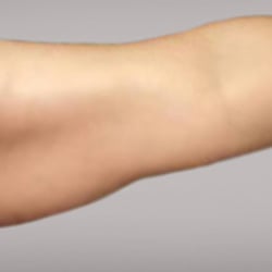 Body Contour Wellness Center - After I had my arms worked on ( amazing results )
