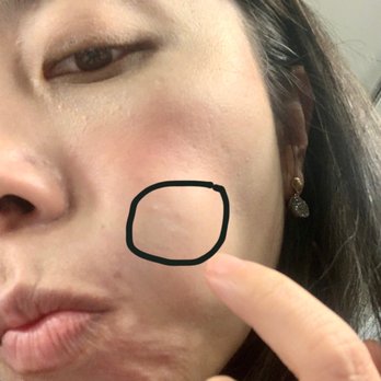 Uyesugi Dental - At night the damage showed on my skin. - Cosmetic Dentists Near Me - San Jose, California Uyesugi Dental - At night the damage showed on my skin. - Cosmetic Dentists Near Me - San Jose, California