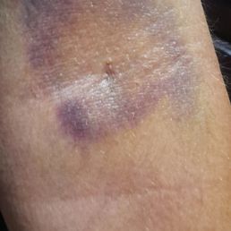 My arm 5 days after the injury