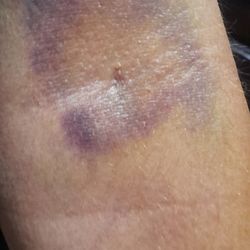 BioLife Plasma Services - My arm 5 days after the injury