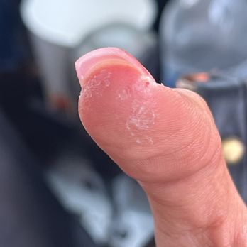 No1 Nails Spa - Broken skin due to negligence of staff. - Nail Salons Near Me - Long Beach, California No1 Nails Spa - Broken skin due to negligence of staff. - Nail Salons Near Me - Long Beach, California