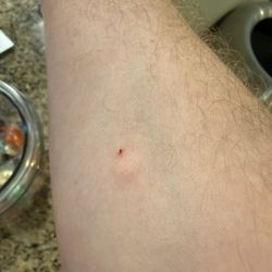MD Now Urgent Care - Correctly placed Intradermal injection by the NP.