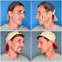 Tattoo Removal Ink