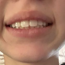 Boren Orthodontics - after 1 year
