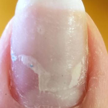 Nail Care - My thick healthy nail is literally peeling from the BOTTOM - Nail Salons Near Me - Arlington Heights, Illinois Nail Care - My thick healthy nail is literally peeling from the BOTTOM - Nail Salons Near Me - Arlington Heights, Illinois