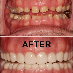 Becker Dental - Full mouth restored with all porcelain crowns due to GERD and grinding caused by sleep apnea.