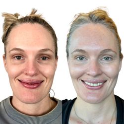 Theresa Carrie Aesthetics - Botox reduces appearance of wrinkles. Filler to temples, under eyes, cheeks refresh her appearance.