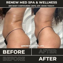 Renew Med Spa & Wellness - Before and after of body contouring, waist snatching session.