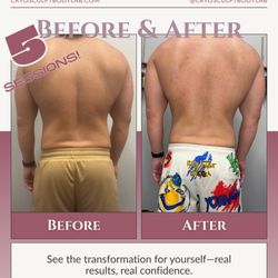 CryoSculpt Body Lab