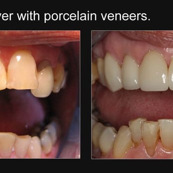 Fred Chao, DDS - Smile makeover with porcelain veneers. - General Dentistry Near Me - Los Angeles, California Fred Chao, DDS - Smile makeover with porcelain veneers. - General Dentistry Near Me - Los Angeles, California