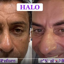 Bolus Med Spa - Customized HALO/TRL with PRP. We deliver results, not treatments off the shelf.