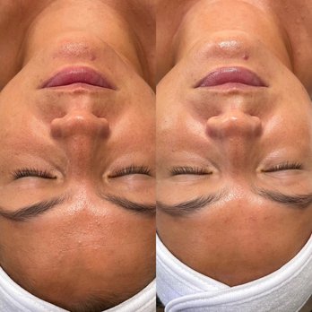 Luxe Skin Bar - Brighten and tighten facial with mini peel add on - Skin Care Near Me - Gilbert, Arizona Luxe Skin Bar - Brighten and tighten facial with mini peel add on - Skin Care Near Me - Gilbert, Arizona