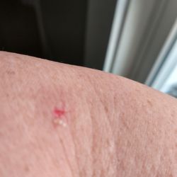 Dartmouth Manor Home - Cigarette burn from maria