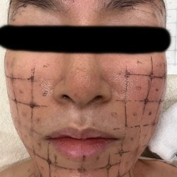 Genesys Laser - prep for Thermage