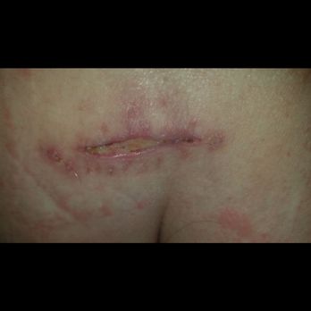 Preferred Spine and Pain - Infected incision - Pain Management Near Me - Round Rock, Texas Preferred Spine and Pain - Infected incision - Pain Management Near Me - Round Rock, Texas