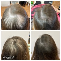 Scalp Micropigmentation or SMP. Exciting new hair loss solution technique.