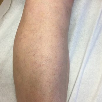 OC MedDerm - This is a month after the first treatment. - Cosmetic Surgeons Near Me - Irvine, California OC MedDerm - This is a month after the first treatment. - Cosmetic Surgeons Near Me - Irvine, California