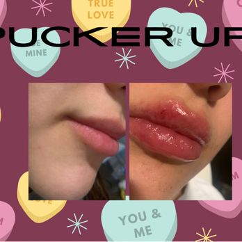 Pucker Up - Before & after with one syringe - Permanent Makeup Near Me Pucker Up - Before & after with one syringe - Permanent Makeup Near Me
