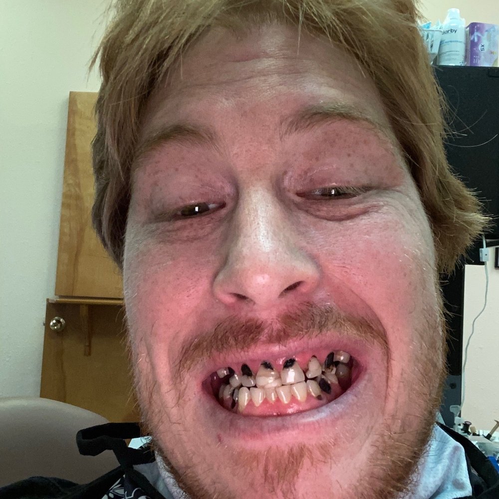 John J Bial DDS PS - Before they worked their magic 3 - Oral Surgeons Near Me - Bremerton, Washington