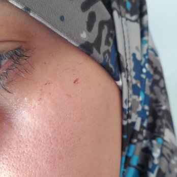 Threading Zone - Scars from face wax under the eye - Hair Salons Near Me - Addison, Illinois Threading Zone - Scars from face wax under the eye - Hair Salons Near Me - Addison, Illinois