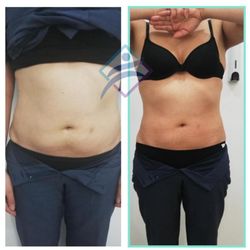 Balance Med Spa - Waist Reduction
Reducción de cintura