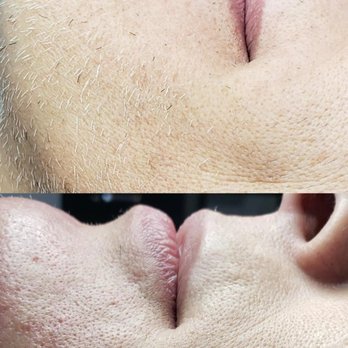 Elite Electrolysis - Hair Removal Near Me - Henderson, Nevada
