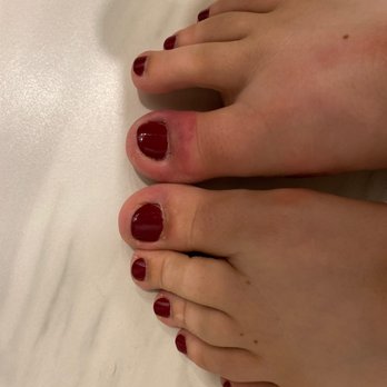 Fingers and Toes - 5 days since I got my nails done. As you can see my toe is still beyond infected... first time and last time ever going here - Nail Salons Near Me - Greenbrae, California